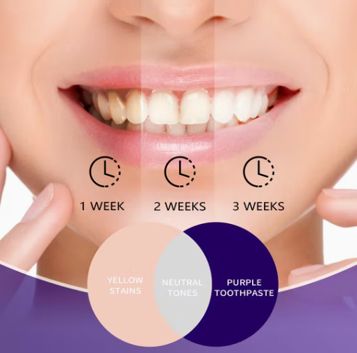 GlorySmile v34™ – Correcteur de Couleur Dentaire